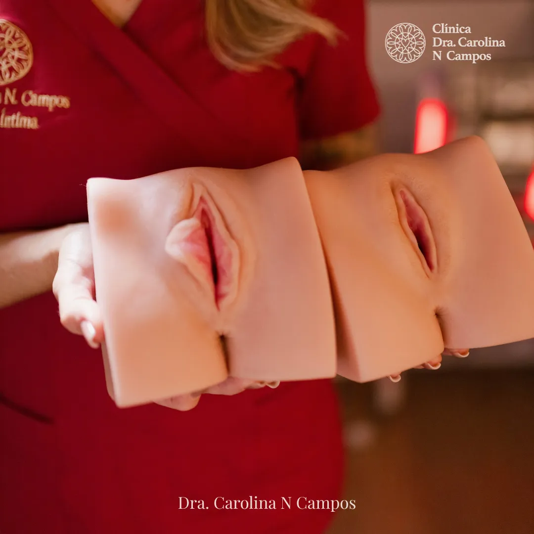 Ninfoplastia: como é a cirurgia